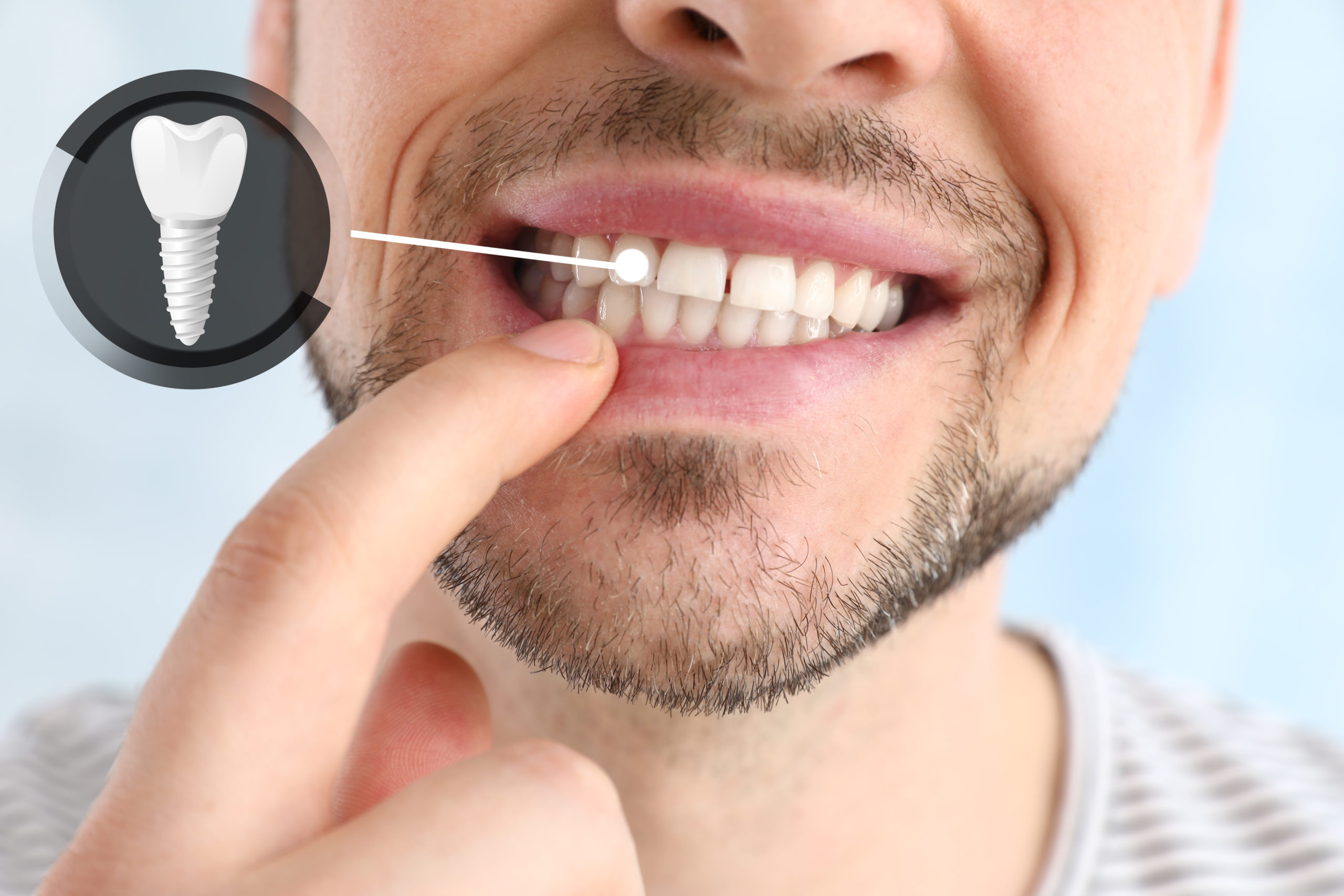 Implantologie - Die Unterstützung für happy smiles - Zahnimplantate sind vielseitig einsetzbar
